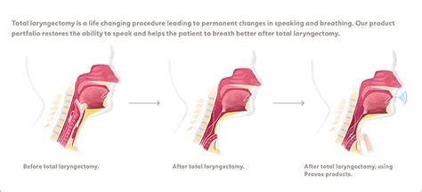 10 Best Clinics for Voice Restoration Surgery in San Sai [2023 Prices]