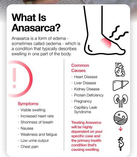 Treatment of Anasarca - MEDizzy