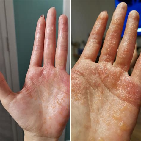 Update on the worst dyshidrosis flare I had in past three years : r/Dyshidrosis