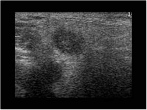 Head and Neck | 4.3 Salivary glands : Case 4.3.4 Warthin's tumors | Ultrasound Cases