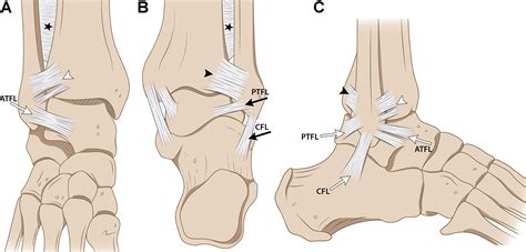 Chronic Ankle Pain And Inflammation Following Atfl Rupture