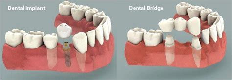 Dental Implant vs Bridge - Which is Best to Replace a Tooth?