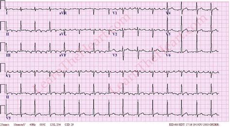 Atrial Flutter With Variable Block