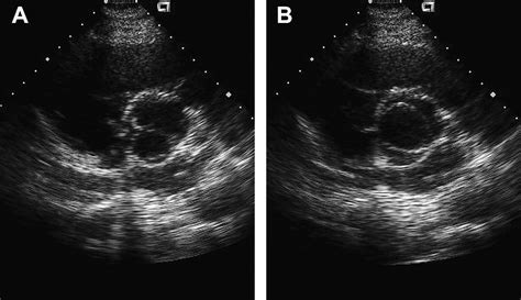 Aortic involvement in patients with a bicuspid aortic valve | Heart