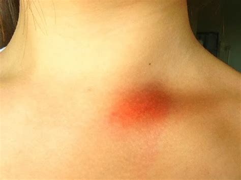 👉 Swollen Collarbone - Causes, Treatment, Pictures (December 2021)