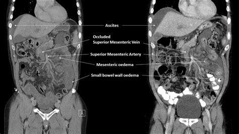 Superior Mesenteric Vein Thrombosis