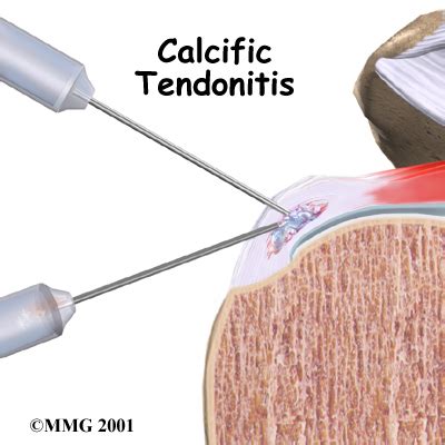 Physical Therapy in Baton Rouge for Shoulder - Calcific Tendonitis