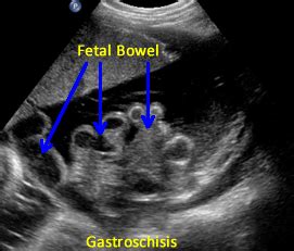 Images for Gastroschisis Diagnostics: Twins and Single Birth