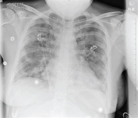 The Effect of Remdesivir and Convalescent Plasma in Severe COVID-19 in Pregnancy