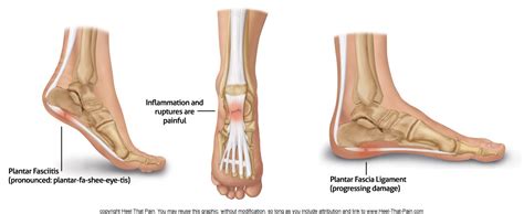 Plantar Fasciitis Treatment