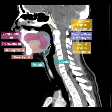 Tonsillar Hypertrophy