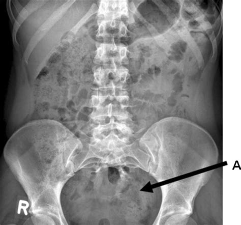 Pelvic X-ray Arrow A: the partial sacral agenesis | Open-i