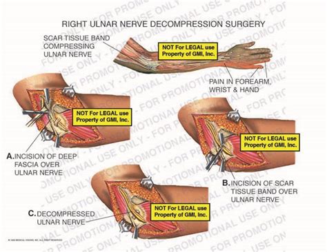 Right Ulnar Nerve Decompression Surgery 98084c31b – Generic Medical Legal Exhibits, A Division ...