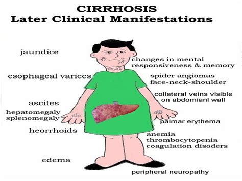 Hello USA: laennec's cirrhosis