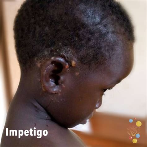 Impetigo - Skin Deep