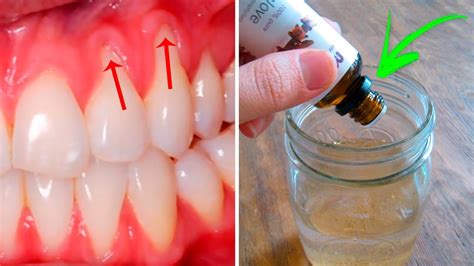 3 Easy Ways to Heal Receding Gums Naturally - YouTube