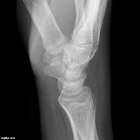 EMRad: Radiologic Approach to the Traumatic Wrist