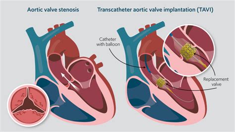 TAVI risks and benefits - Guys and St Thomas Specialist Care