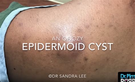 An OOZY Epidermoid Cyst – 33 Recipes | Epidermoid cyst, Cysts, Natural ...