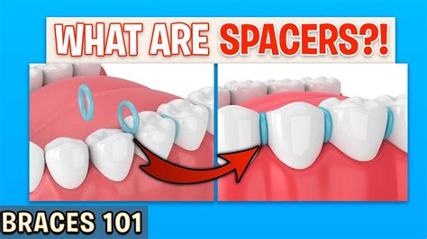 BRACES 101: Spacers For Braces?! | Treatment Minute Talk! - YouTube