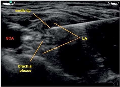 Ultrasound-Guided Supraclavicular Brachial Plexus Block : WFSA - Resources