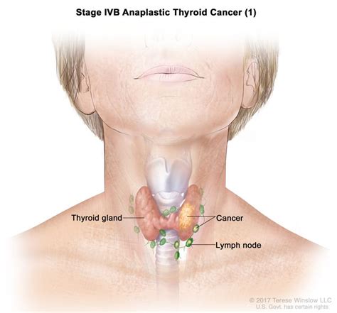 Thyroid Cancer | UCSF Department of Surgery