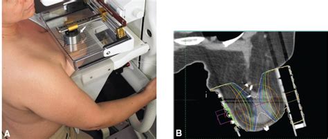 Breast Brachytherapy | Radiology Key