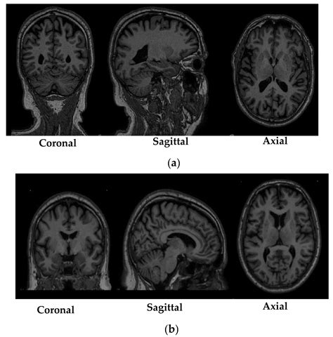 Diagnostics | Free Full-Text | Detection of Parkinson’s Disease from 3T T1 Weighted MRI Scans ...