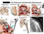 AMICUS Illustration of amicus,surgery,reverse,total,shoulder ...