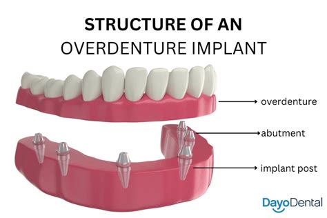 Snap on Dentures vs All on 4: A Comprehensive Guide