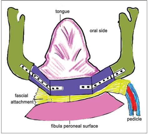 Diagrammatic representation of the left free fibula flap with left side... | Download Scientific ...