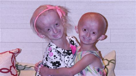 Engineered Living-Cell Blood Vessel Provides New Insights to Progeria ...