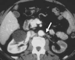 Renal Volume Loss Renal Atrophy - Clinical Radiology - GUWS Medical