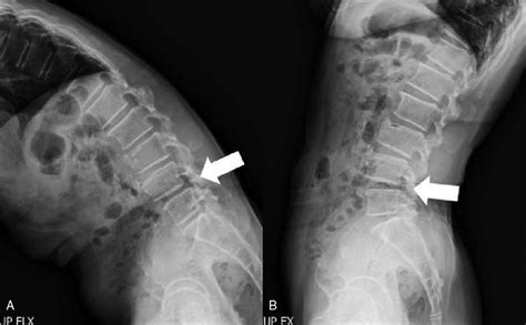 (A) Flexion view. (B) Extension view. Lumbar spine radiographs show... | Download Scientific Diagram