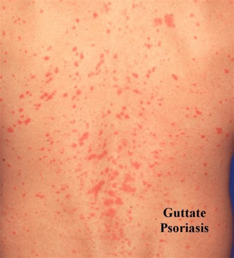 The Best Guttate Psoriasis Treatment Options & 7 Tips to Prevent Breakouts - Be Your Best, Well ...