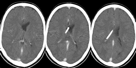 Dr Balaji Anvekar FRCR: Post shunt lateral ventricle asymmetry