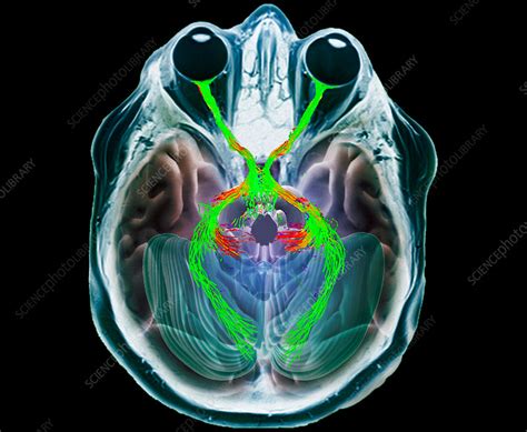 Optic chiasma, DTI MRI scan - Stock Image - C037/2996 - Science Photo ...