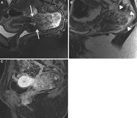 Degenerated subserosal fibroid exophytic from the lower uterine segment ...