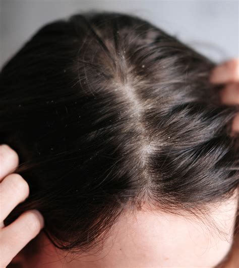 Scalp Build Up: Definition, Causes, And How To Get Rid Of