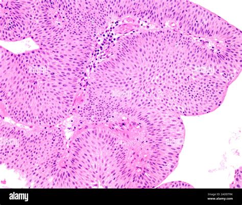 Light micrograph of low-grade papillary urothelial carcinoma (also ...