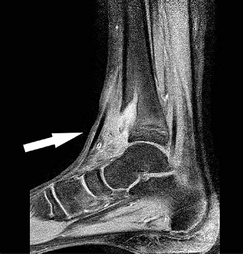 Cureus | Brodie's Abscess: A Diagnostic Conundrum