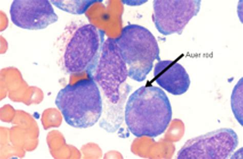 Acute Granulocytic Leukemia