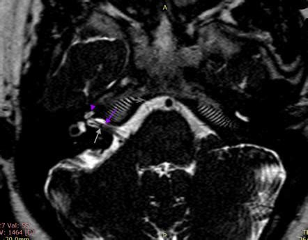 Vestibulocochlear nerve | Radiology Reference Article | Radiopaedia.org