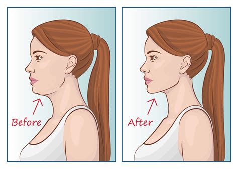 Jawline Contouring in Virginia, Washington D.C. & Maryland