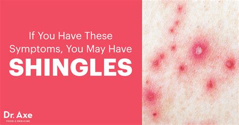 Shingles Symptoms, Common Risk Factors & Causes - Dr. Axe