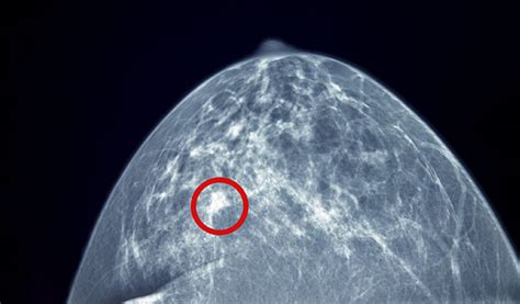 Diagnostic Mammogram