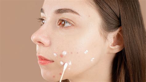 Retinoids for Acne: How to use, FAQs & side effects – Minimalist