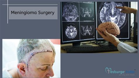 Meningioma Surgery Cost In India | Medsurge India