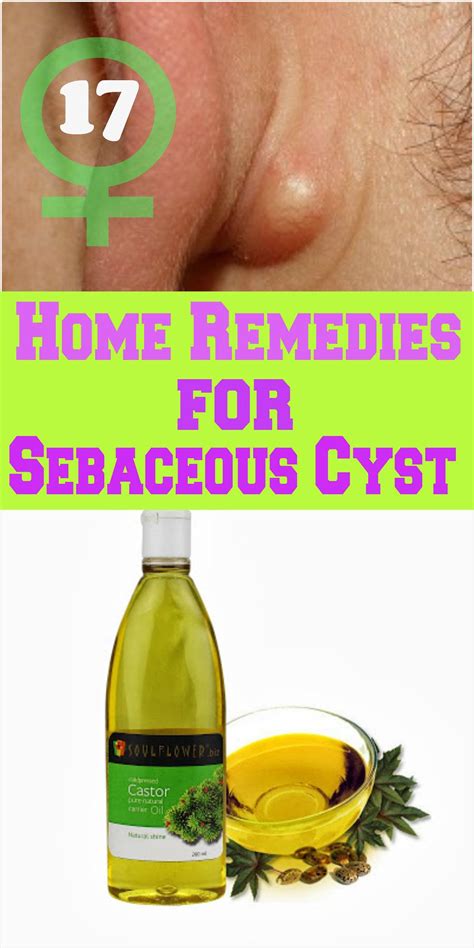 17 Home Remedies for Sebaceous Cyst | Natural health tips, Home remedies, Holistic remedies