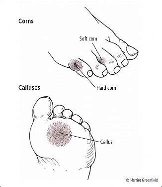 Calluses and corns - Harvard Health